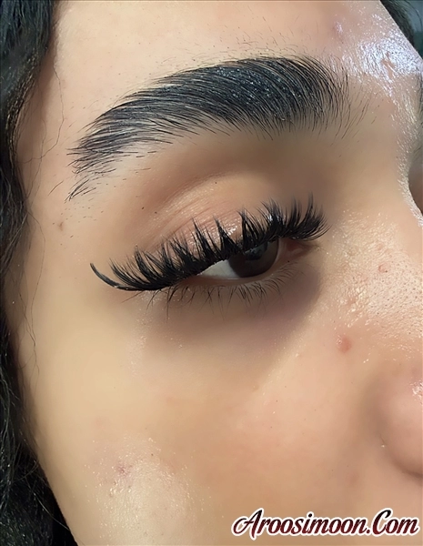 کاشت موقت نیمه ژورنالی