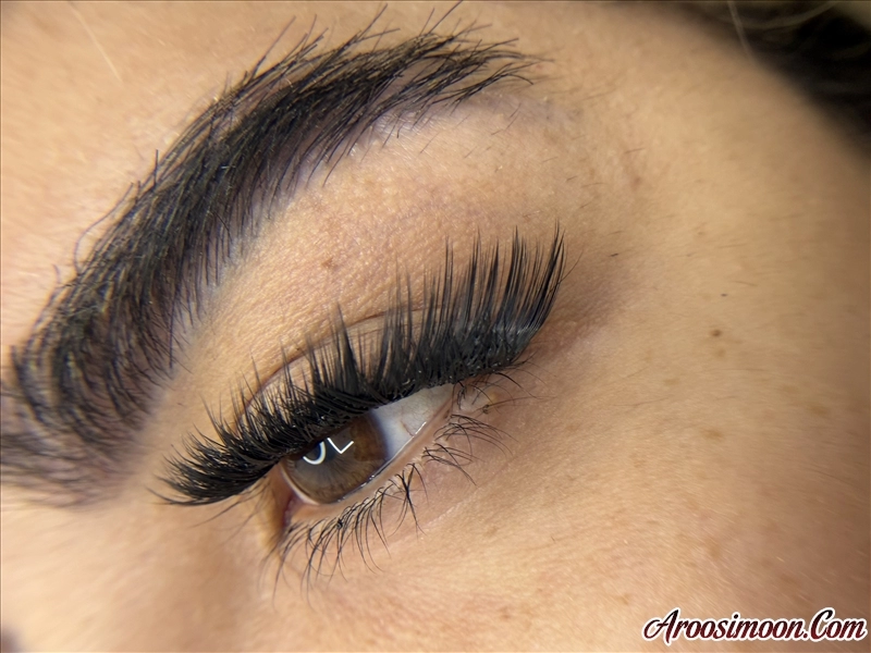 کاشت موقت پرستویی